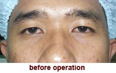 plastic-surgery-blepharoplasty